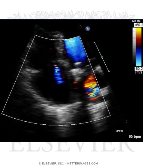 Color Doppler Four-Chamber View Showing Reversed Flow From the Right Ventricle Into the Right Atrium Through a Leaky Tricuspid Valve During Systole