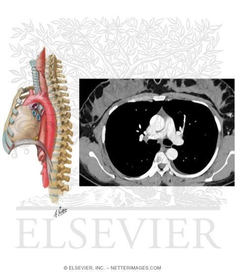 T4-T5 CT With a Lung Window