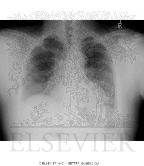Expiration View With Elevated Diaphragm