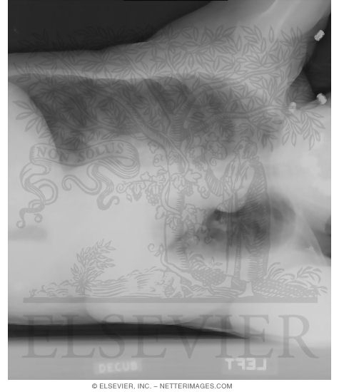 Left Lateral Decubitus View