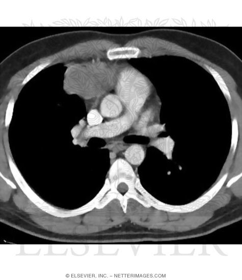 Search Strategy: Mediastinum and Hila