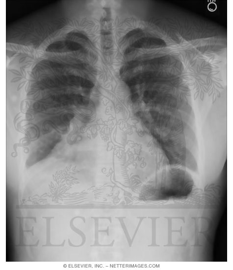 Search Strategy: Lungs - Silhouette Sign