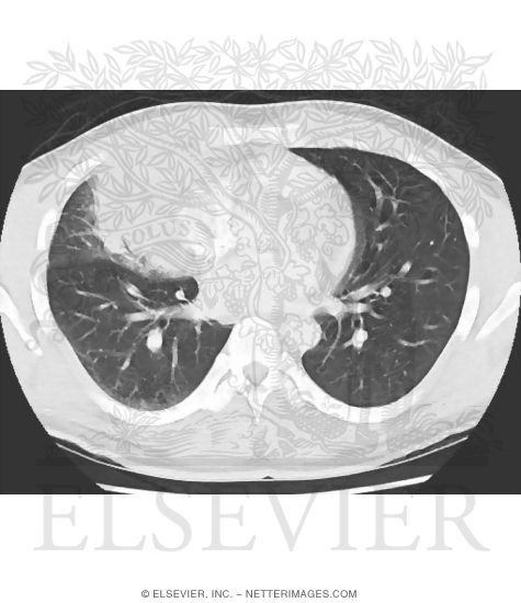 Search Strategy: Lungs - Silhouette Sign