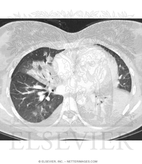 Search Strategy: Lungs - Silhouette Sign