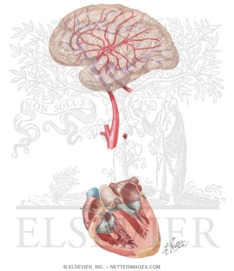 Stroke As a Result of Cardiac Embolus