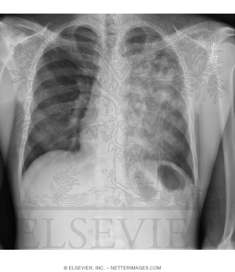 Search Strategy: Lungs, Alveolar Vs. Interstitial Opacity