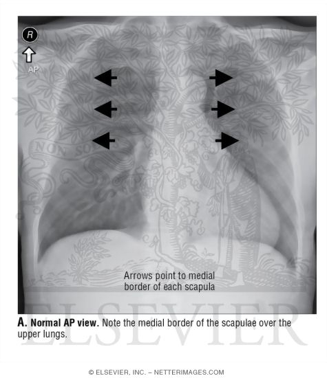 Watermarked preview of unlabeled image: Normal AP View