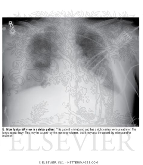 Watermarked preview of unlabeled image: More Typical AP View In a Sicker Patient