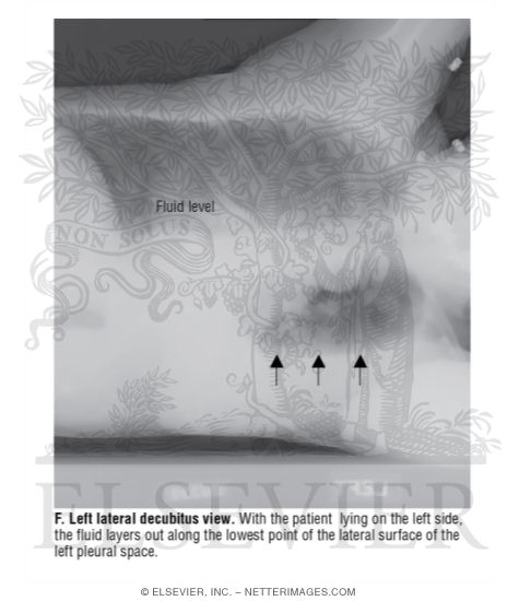 Left Lateral Decubitus View