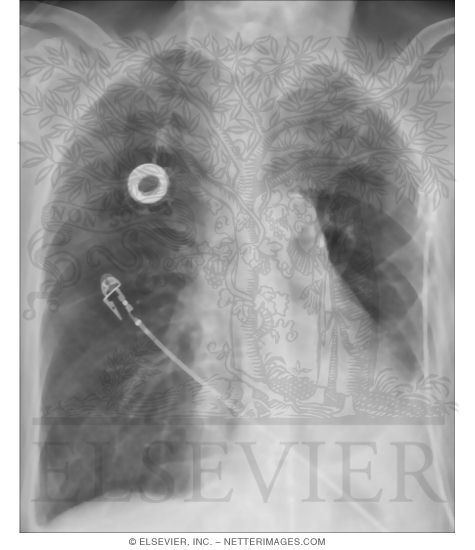 Watermarked preview of unlabeled image: Search Strategy: Pleural Spaces and Diaphragm