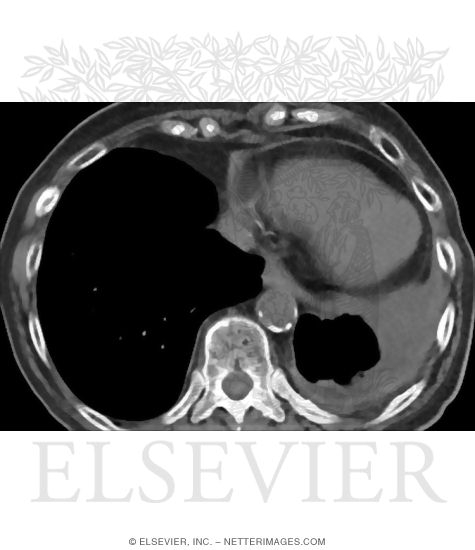 Watermarked preview of unlabeled image: Search Strategy: Pleural Spaces and Diaphragm