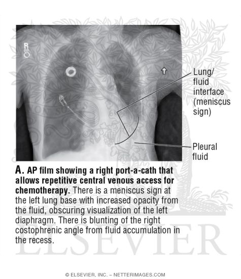 Watermarked preview of unlabeled image: Search Strategy: Pleural Spaces and Diaphragm