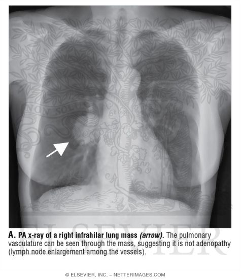 Search Strategy: Mediastinum and Hila