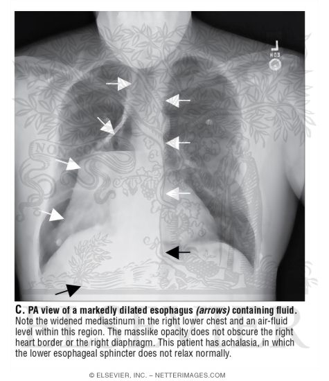 Search Strategy: Mediastinum and Hila