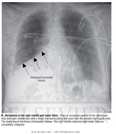 Search Strategy: Lungs, Atelectasis