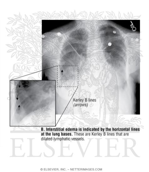 Search Strategy: Lungs, Alveolar Vs. Interstitial Opacity