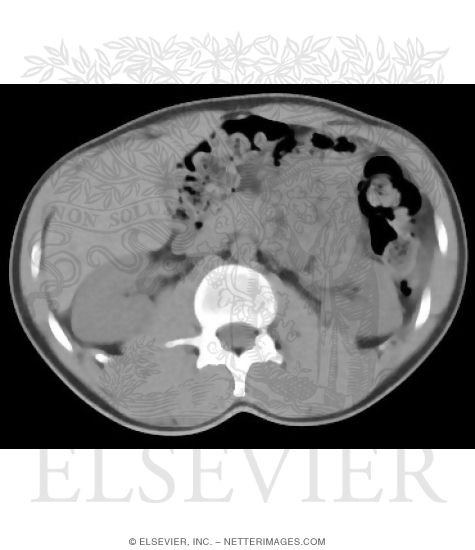 CT Vs. MRI In Abdominal Studies