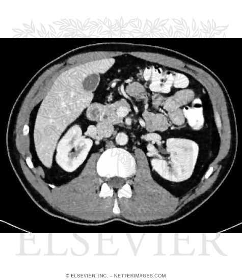 CT Vs. MRI In Abdominal Studies
