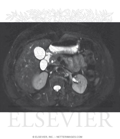 CT Vs. MRI In Abdominal Studies