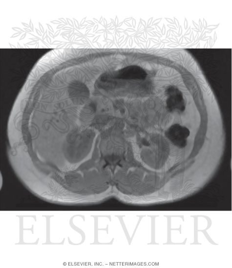 CT Vs. MRI In Abdominal Studies
