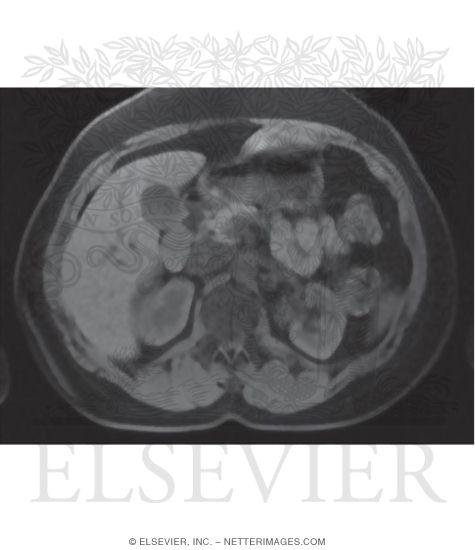 CT Vs. MRI In Abdominal Studies
