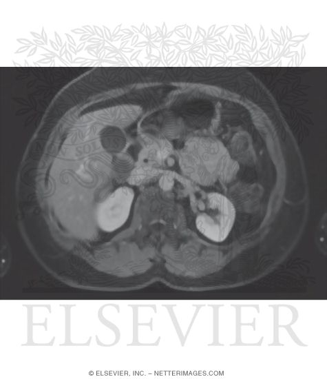 CT Vs. MRI In Abdominal Studies