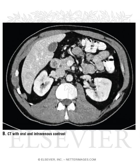 CT Vs. MRI In Abdominal Studies