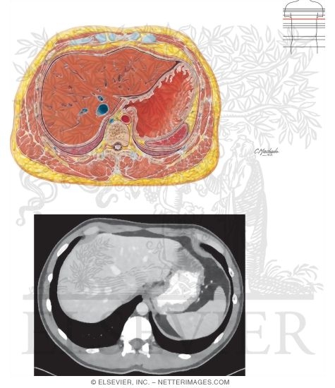 Cross Section at T10 With CT