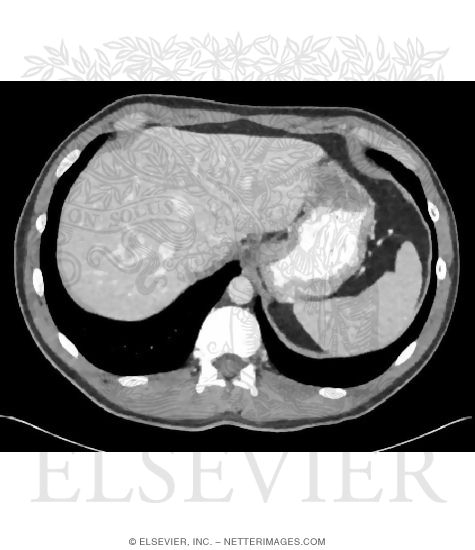 Cross Section at T10 With CT