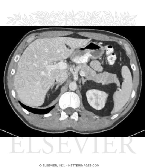 Cross Section at T12 With CT