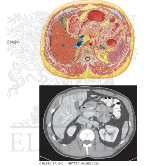 Cross Section Variation at T12 With CT