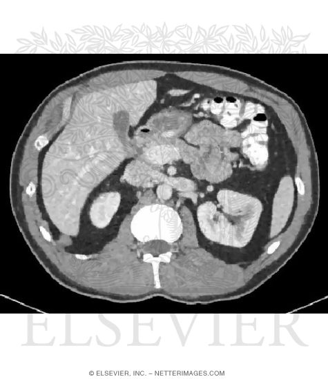 Cross Section Variation at T12 With CT