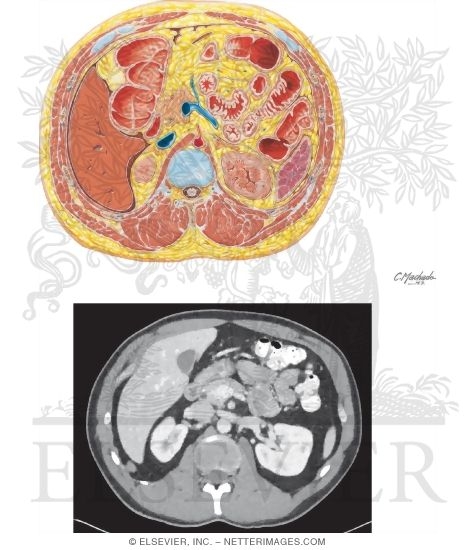 Cross Section at T12-L1 With CT