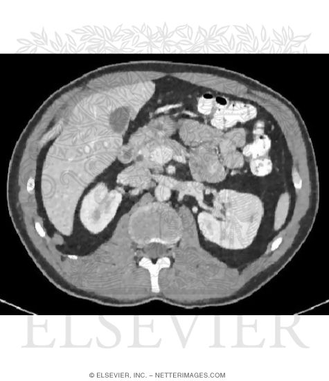 Cross Section at T12-L1 With CT