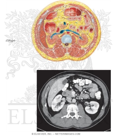 Cross Section at L1-L2 With CT