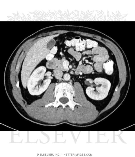 Cross Section at L1-L2 With CT