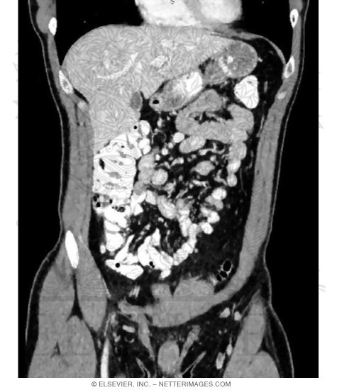 Upper Gastrointestinal CT Studies