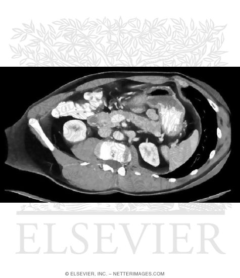 Upper Gastrointestinal CT Studies