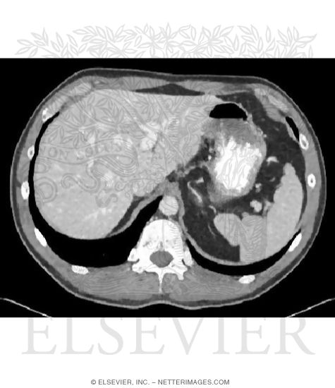 Upper Gastrointestinal CT Studies