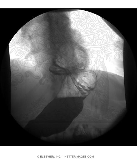 Hiatal Hernia