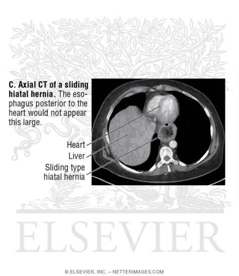 Hiatal Hernia