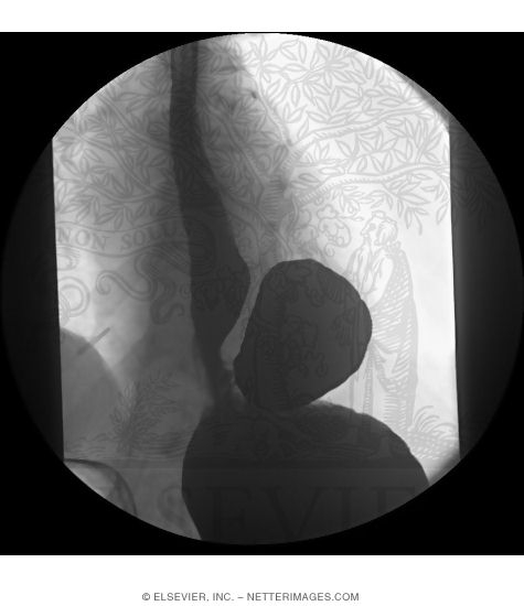 Hiatal Hernia