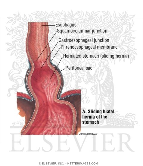 Hiatal Hernia