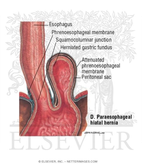 Hiatal Hernia