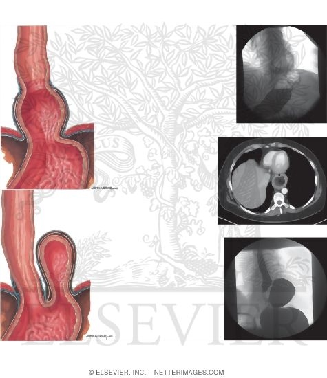 Hiatal Hernia