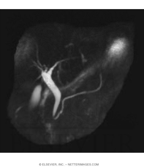 Gallbladder, Bile Ducts, and Pancreatic Duct