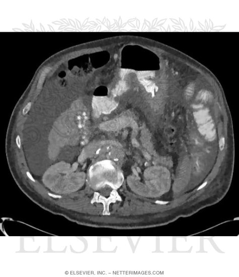 Free Fluid In the Peritoneal Cavity (Ascites) Free Fluid In the Peritoneal Cavity (Ascites)