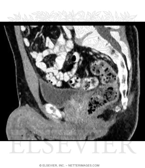 Median CT of Male Pelvis