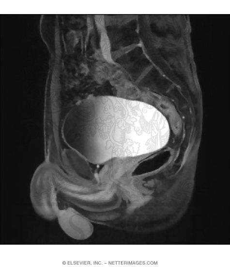 Median T1-Weighted MRI With Contrast of Male Pelvis With a Full Bladder