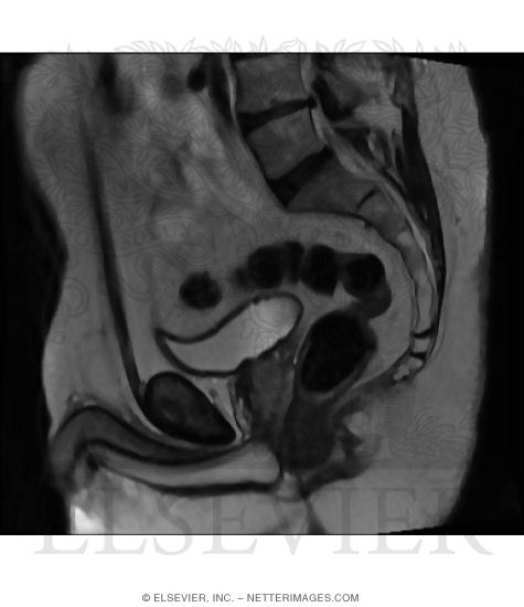Median T2-Weighted MRI of Male Pelvis